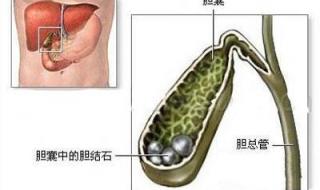 胆囊结石一般如何治疗